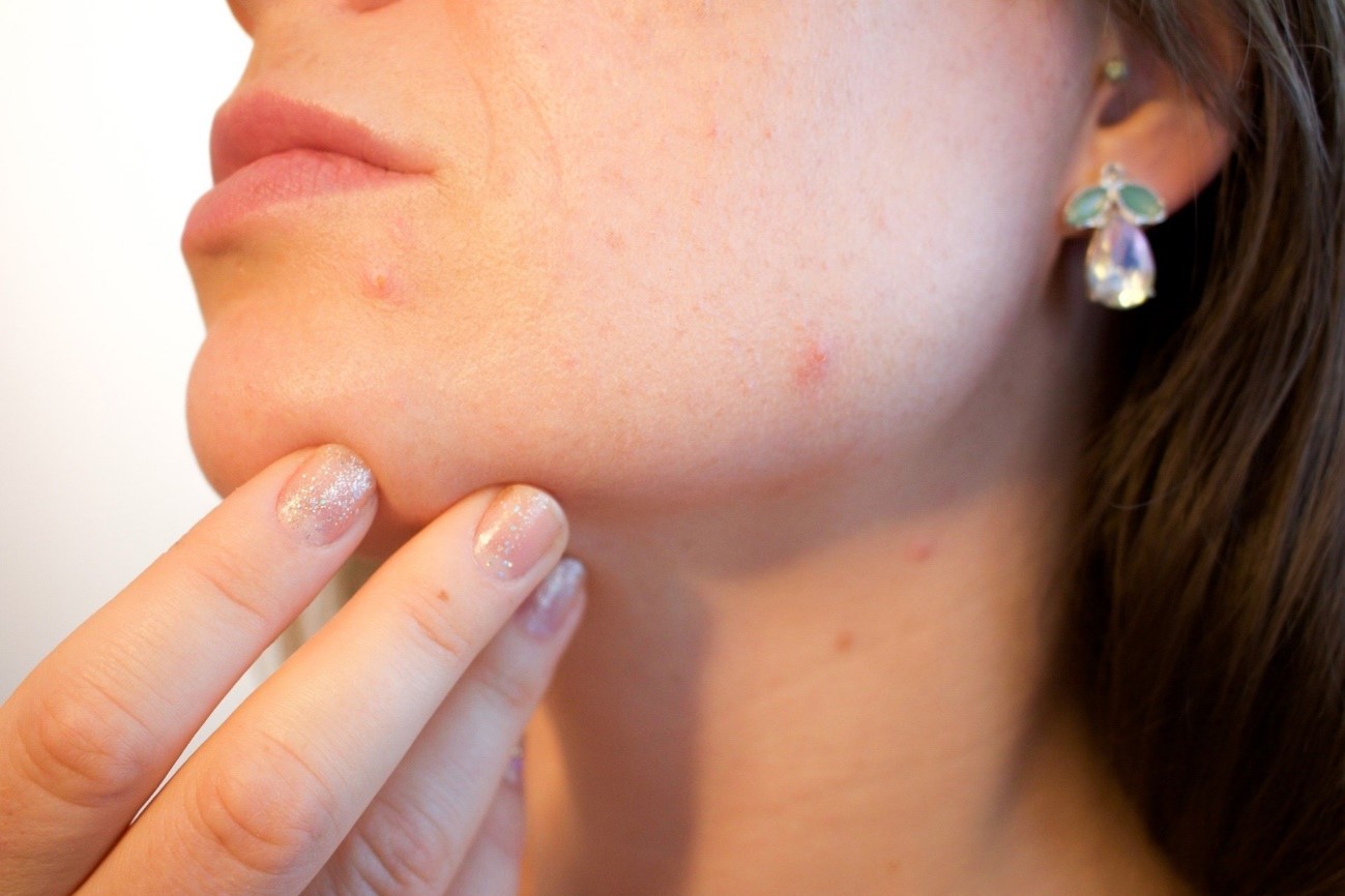 6 consejos eficaces para aliviar el acné 