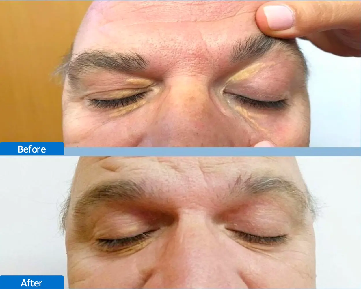 laser CO2 Antes y Despues 10