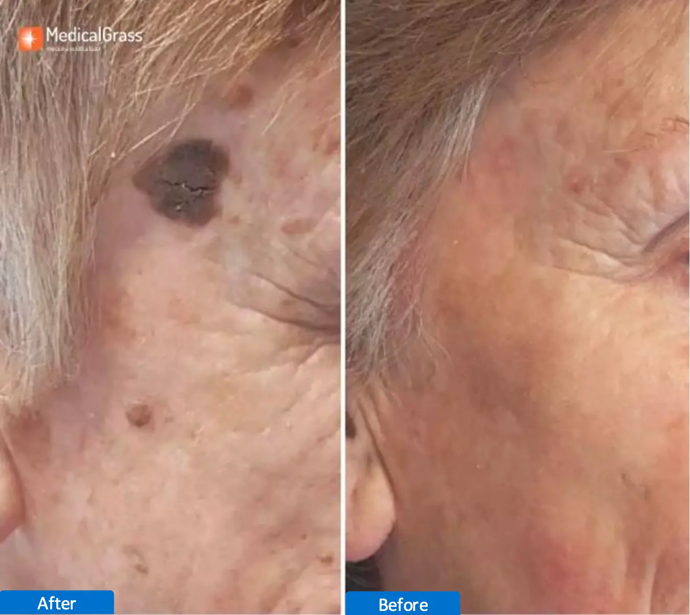 laser CO2 Antes y Despues 4