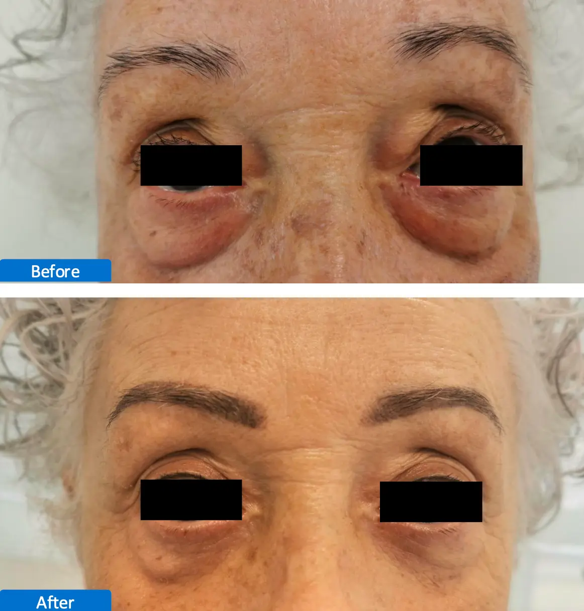 laser CO2 Antes y Despues 6