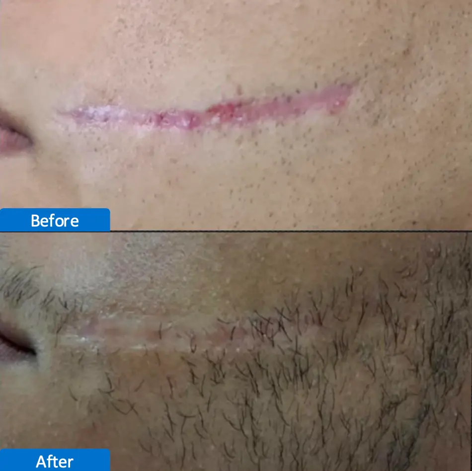 laser CO2 Antes y Despues 8