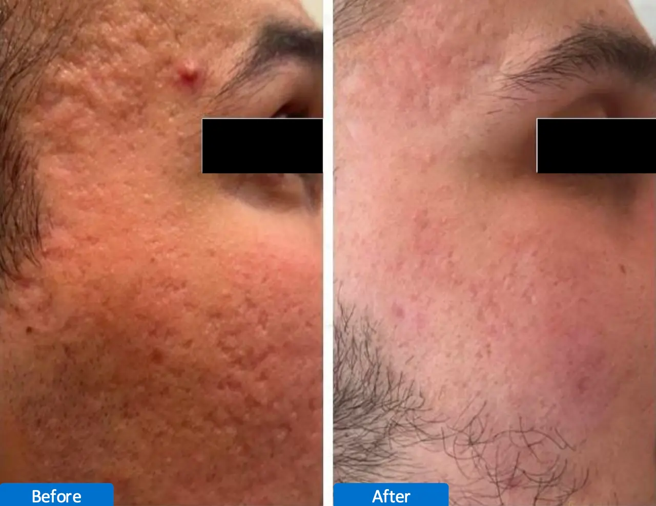 laser CO2 Antes y Despues 9